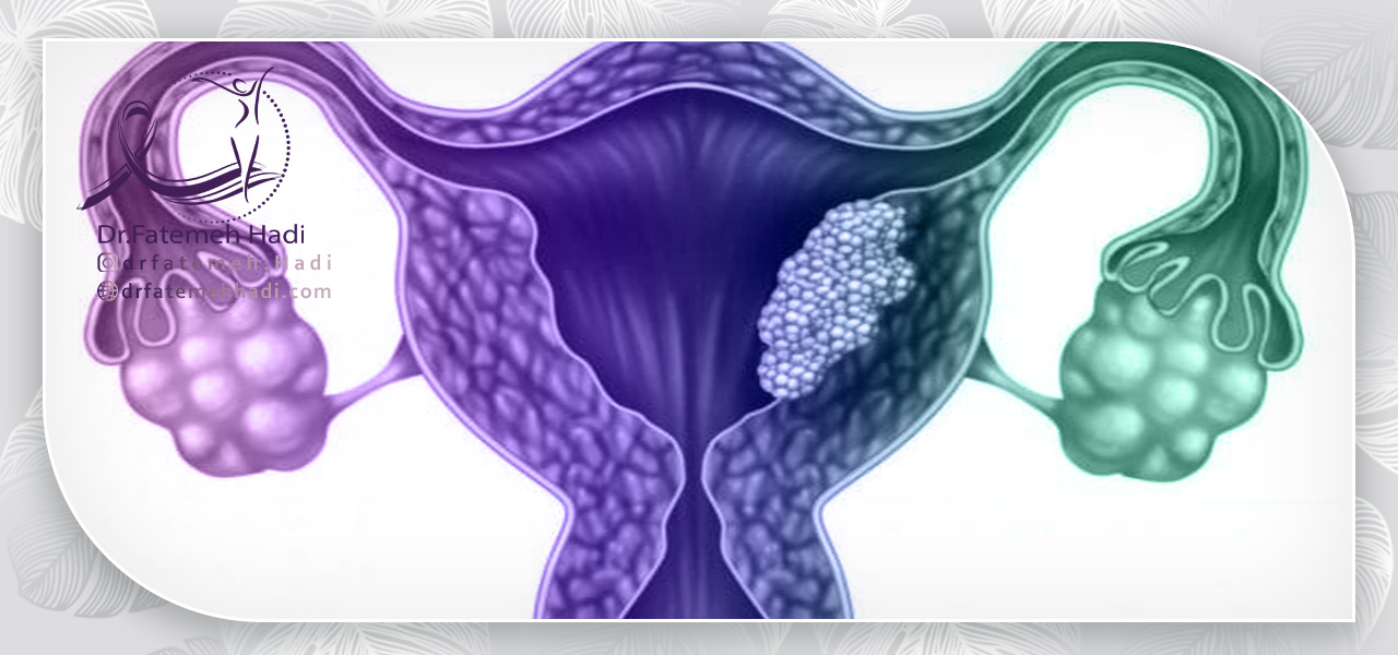 علائم ابتلا به سرطان رحم