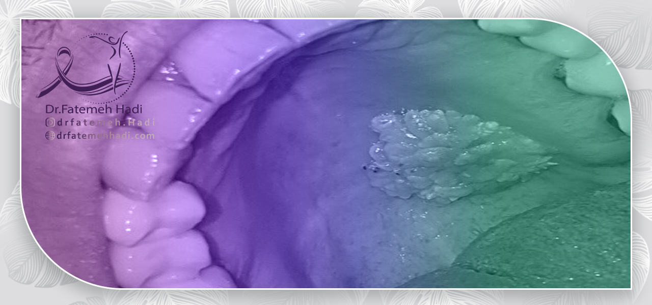 علائمی که ریسک ابتلا به بیماری اچ پی وی را افزایش می دهد