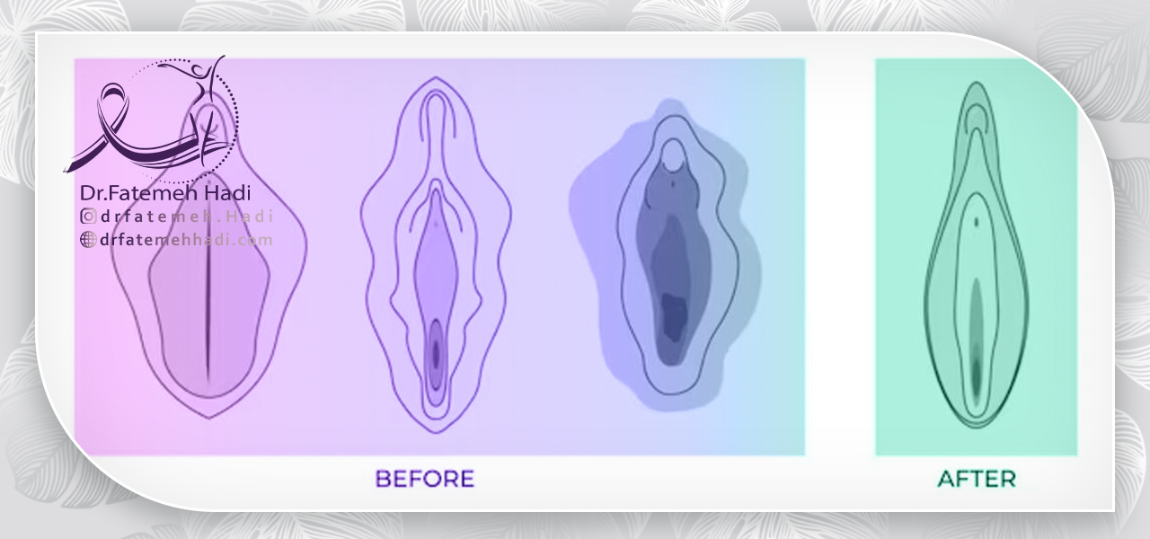 انواع روشهای لابیاپلاستی