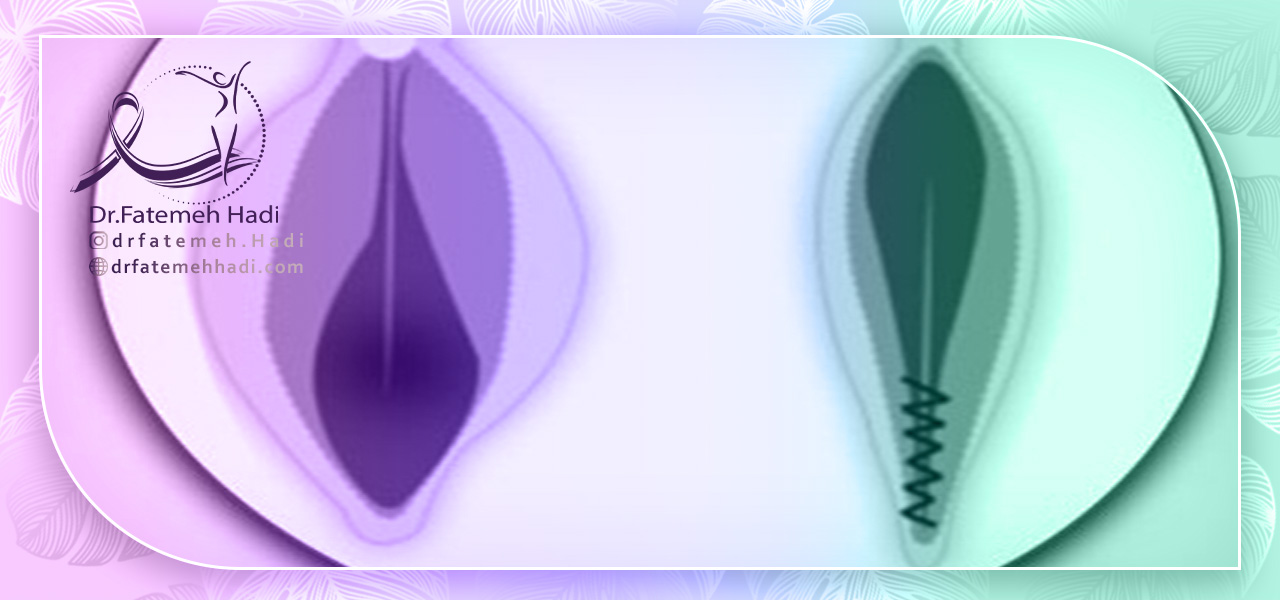 دلیل شلی واژن