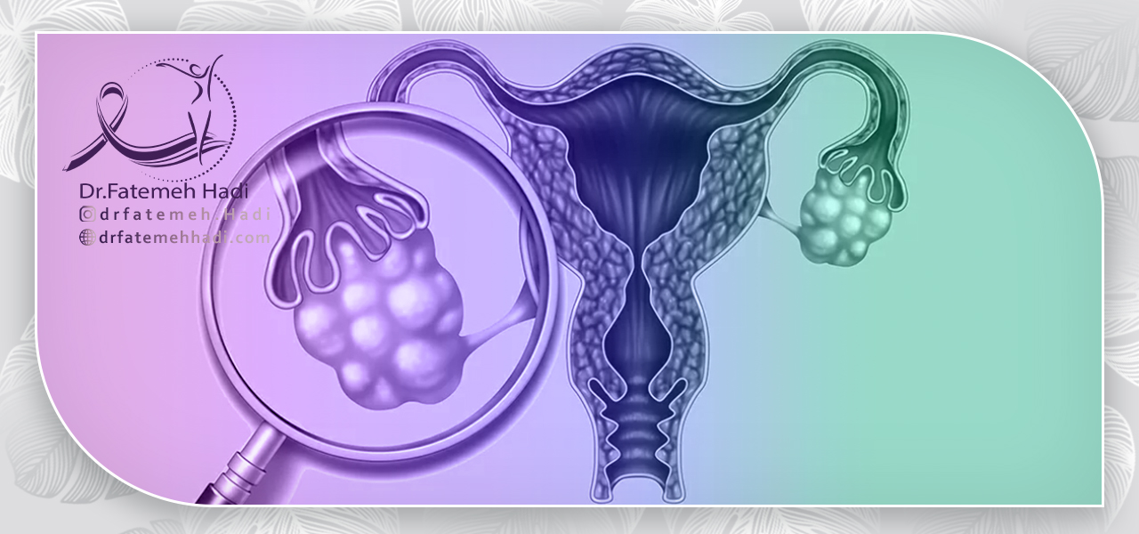 انواع کیست تخمدان