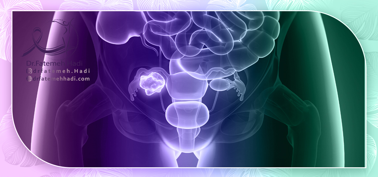 علت ایجاد کیست های تخمدانی